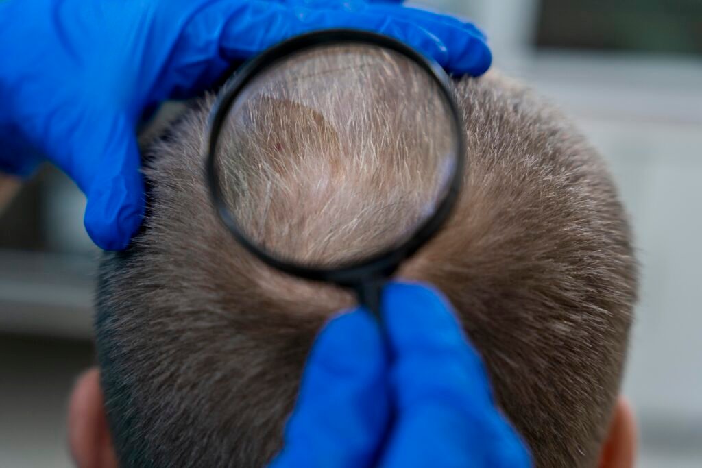 adult male having balding problems