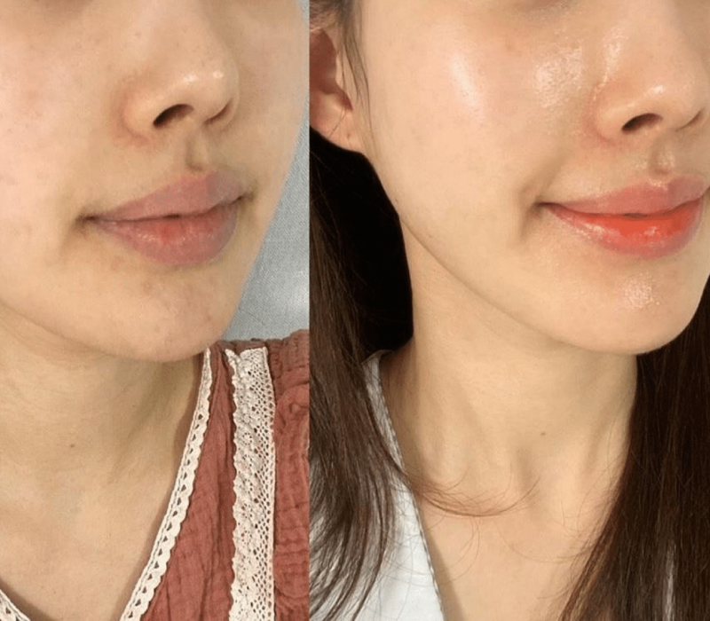 Exosomes Treatment for Skin